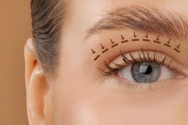 تجميل جفن العين