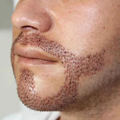 زرع الذقن والحاجب