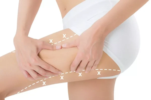 علاج الترهل في الذراعين والساقين